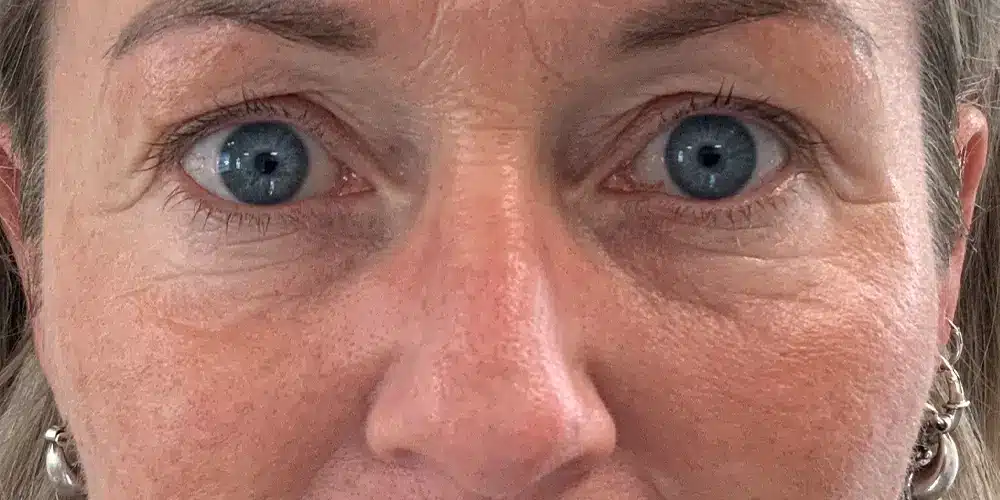 Looks Clinics beginfase behandeling