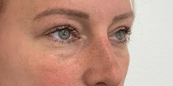 Looks Clinics effect na de behandeling