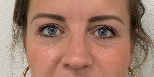 Looks Clinics na afloop behandeling