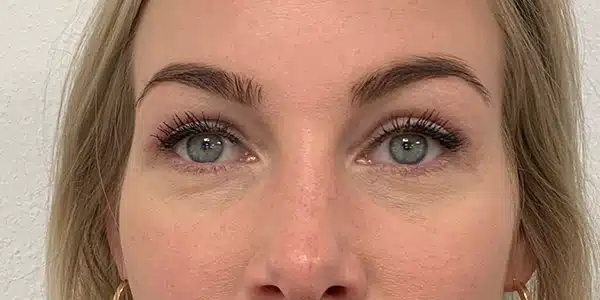 Looks Clinics post behandeling
