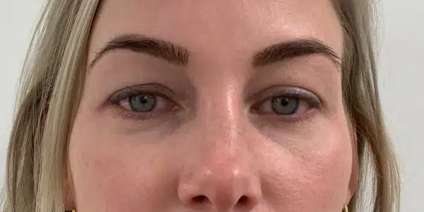 Looks Clinics pre behandeling