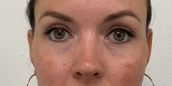 Looks Clinics resultaat na de behandeling