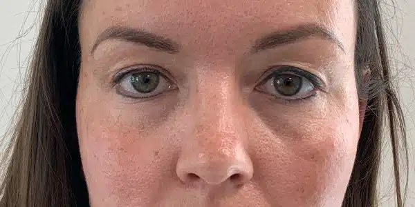 Looks Clinics voorafgaand de behandeling