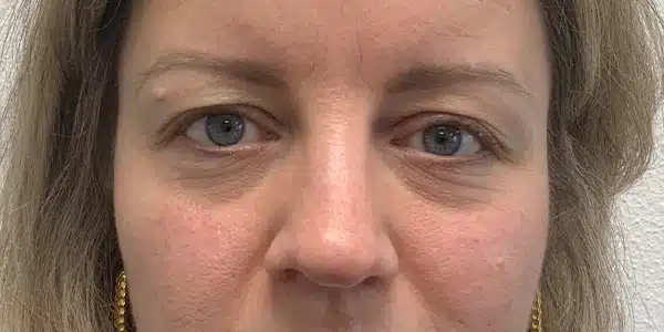 Looks Clinics voordat de behandeling begint