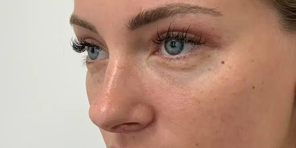 After Eyelid Correction Recovery