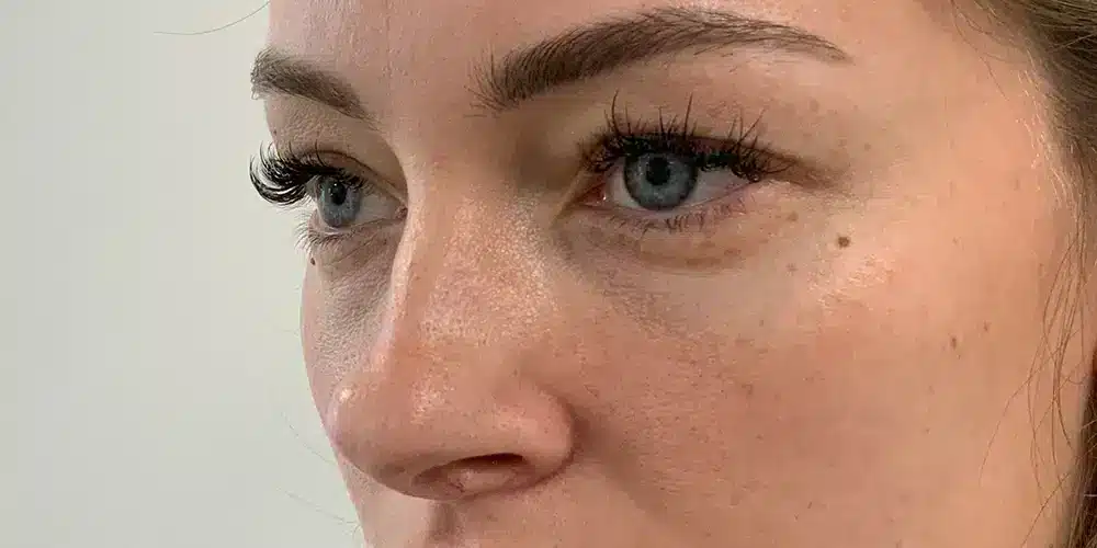 For Eyelid Correction Recovery
